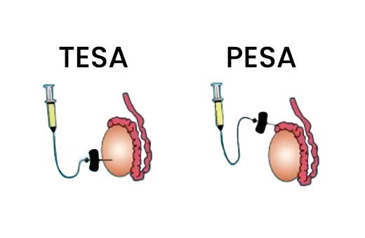 TESA / PESA